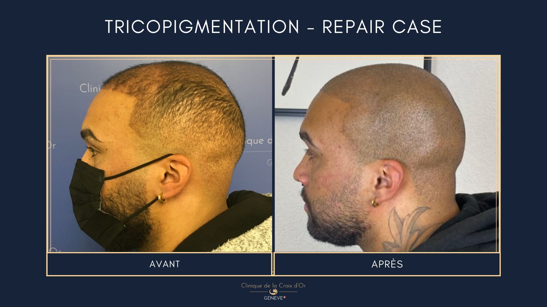 Tricopigmentation
